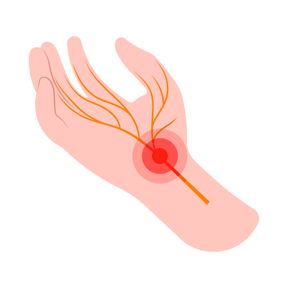 Small Fiber Neuropathy
